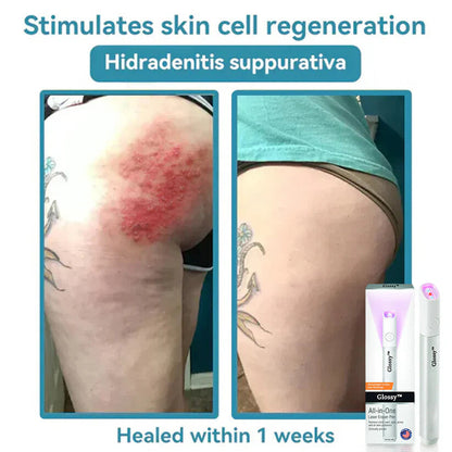 ✨✨Glossy™ All-in-One CO₂ Laser Eraser Pen | Removes Moles, Warts, Skin Flaws & Pigmentation